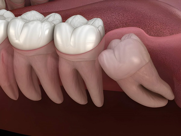 Best Wisdom tooth Surgeon in kharghar